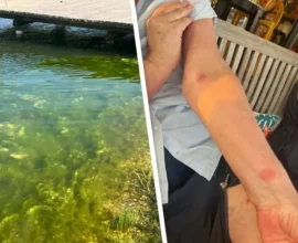 Burger Gölü’nde Deri Döküntüsü ve Yoğun Alg Tabakası Şikayetleri Artıyor