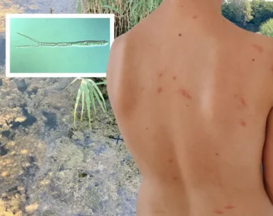 Göl Kenarında Tehlike: Entenflöhe (Ördek Piresi) Vakası Çocukları Vuruyor