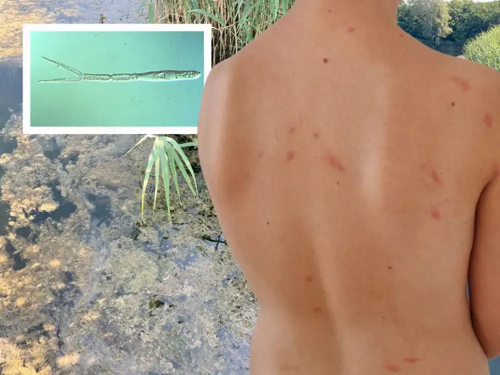 Göl Kenarında Tehlike: Entenflöhe (Ördek Piresi) Vakası Çocukları Vuruyor Göl Kenarında Tehlike: Entenflöhe (Ördek Piresi) Vakası Çocukları Vuruyor