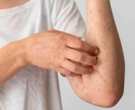 Viyana’da Kızamık ve Hepatit Vakaları Alarm Veriyor